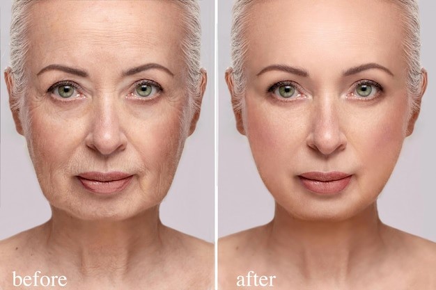 Benefits of Full Face Botox Compared to Targeted Injections